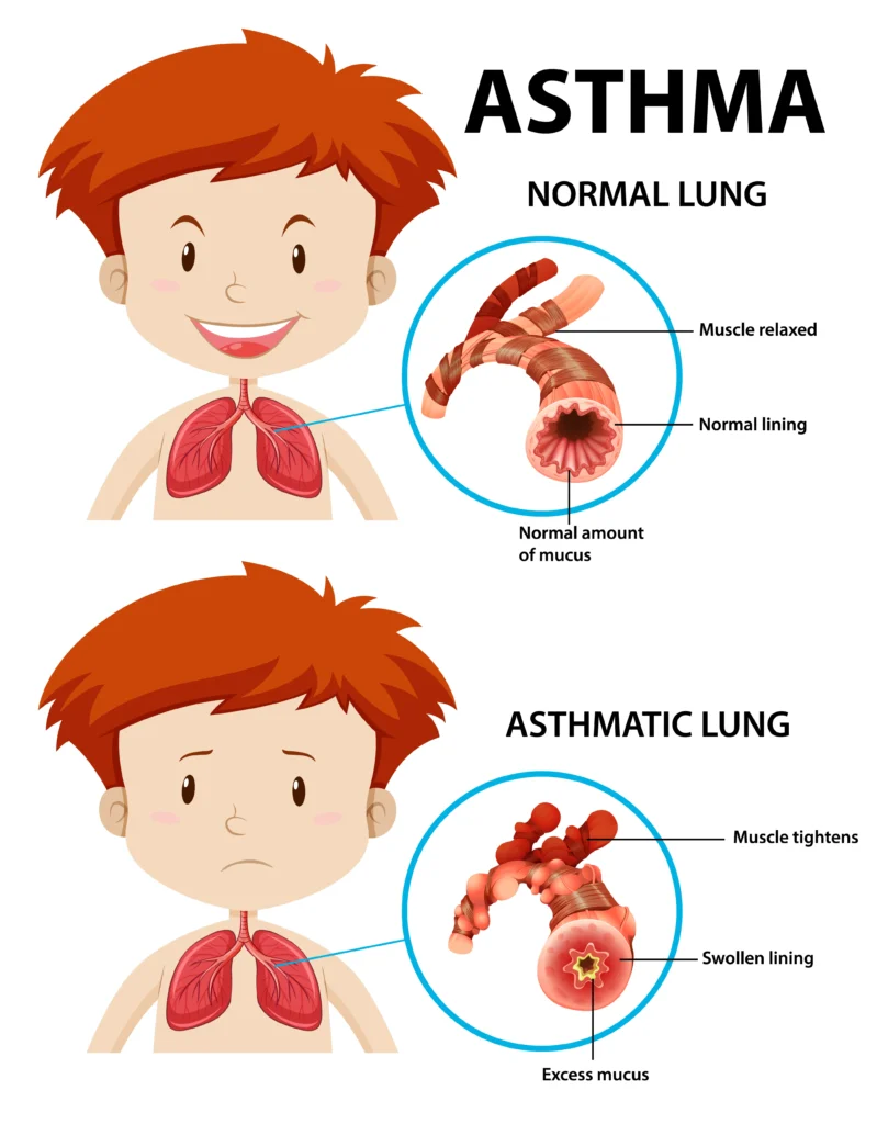 child asthama doctor in mathura